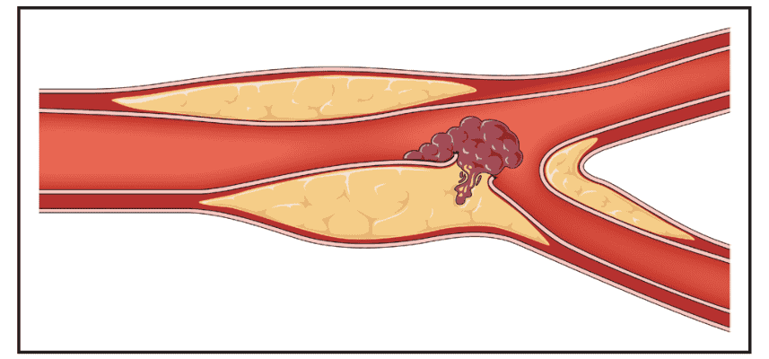 ACS 2025 — Figure 1 Type 1 MI 病生理