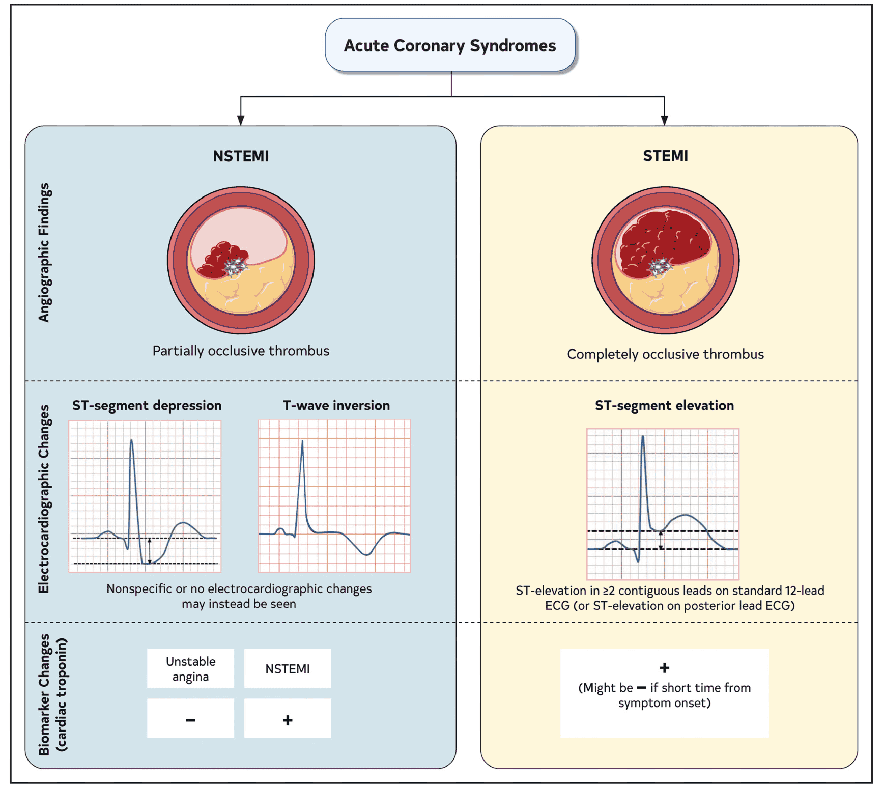 ACS 2025 — Figure 2 ACS 分型
