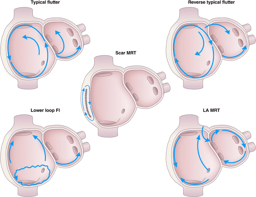 2023 ACC/AHA AF — Figure 6 Types of Atrial Flutter and Macroreentrant Atrial Tachycardia