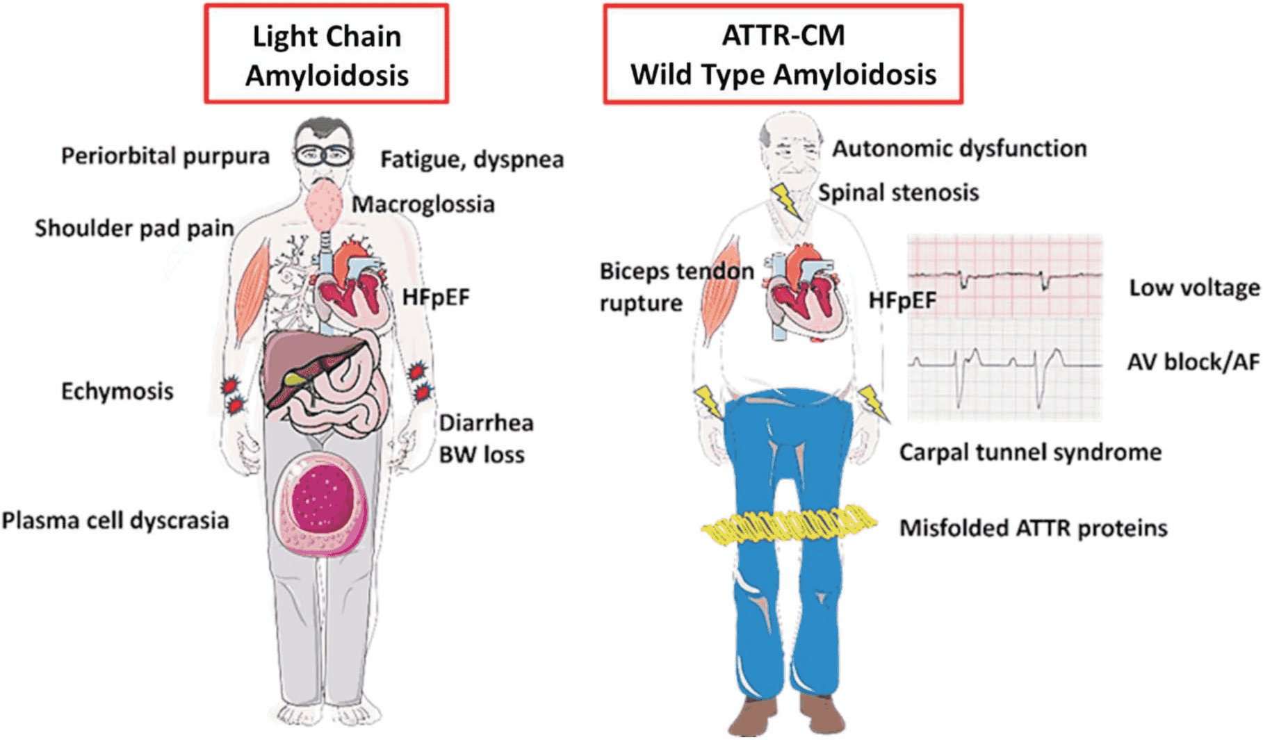 Amyloidosis 共識 — Figure 1 定義