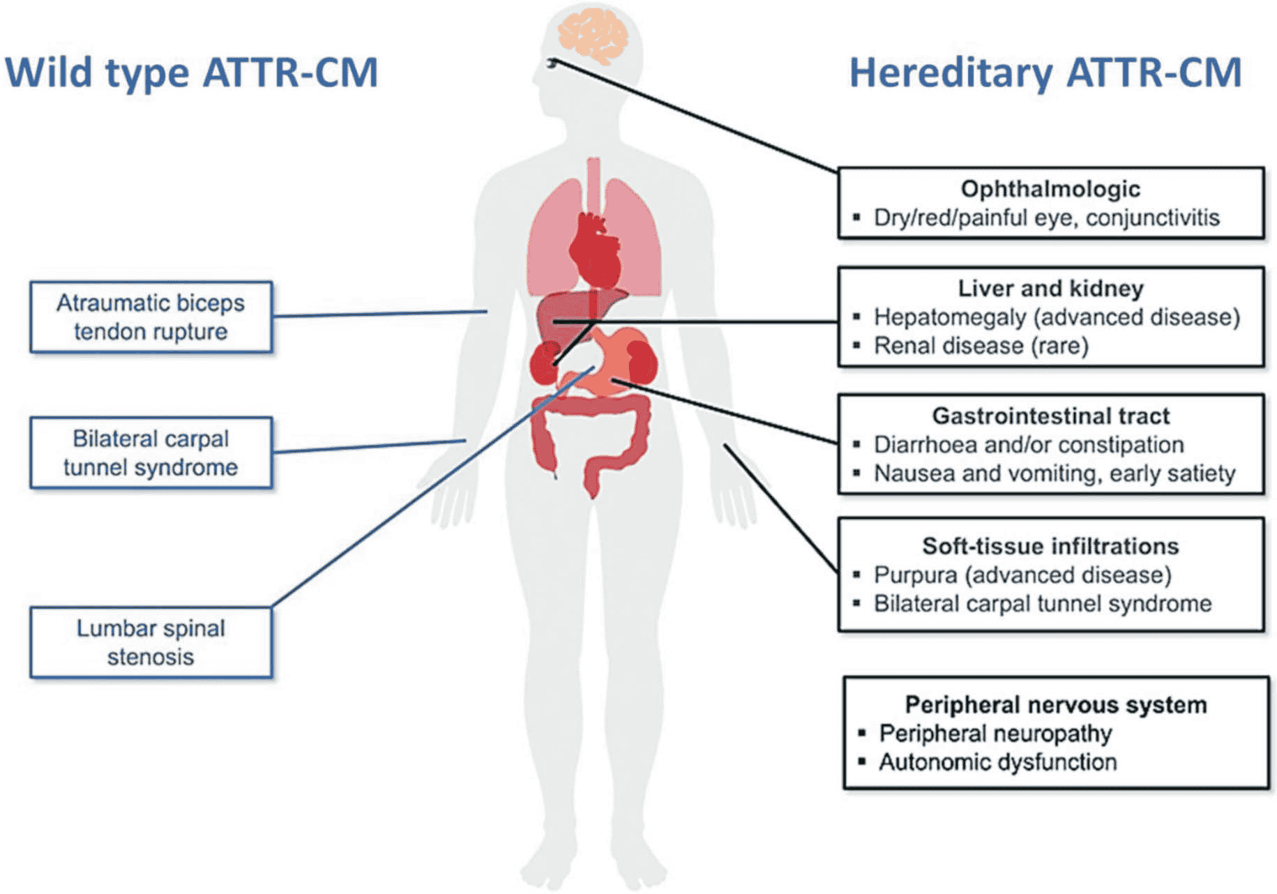 Amyloidosis 共識 — Figure 2 ATTR 心臟外表現