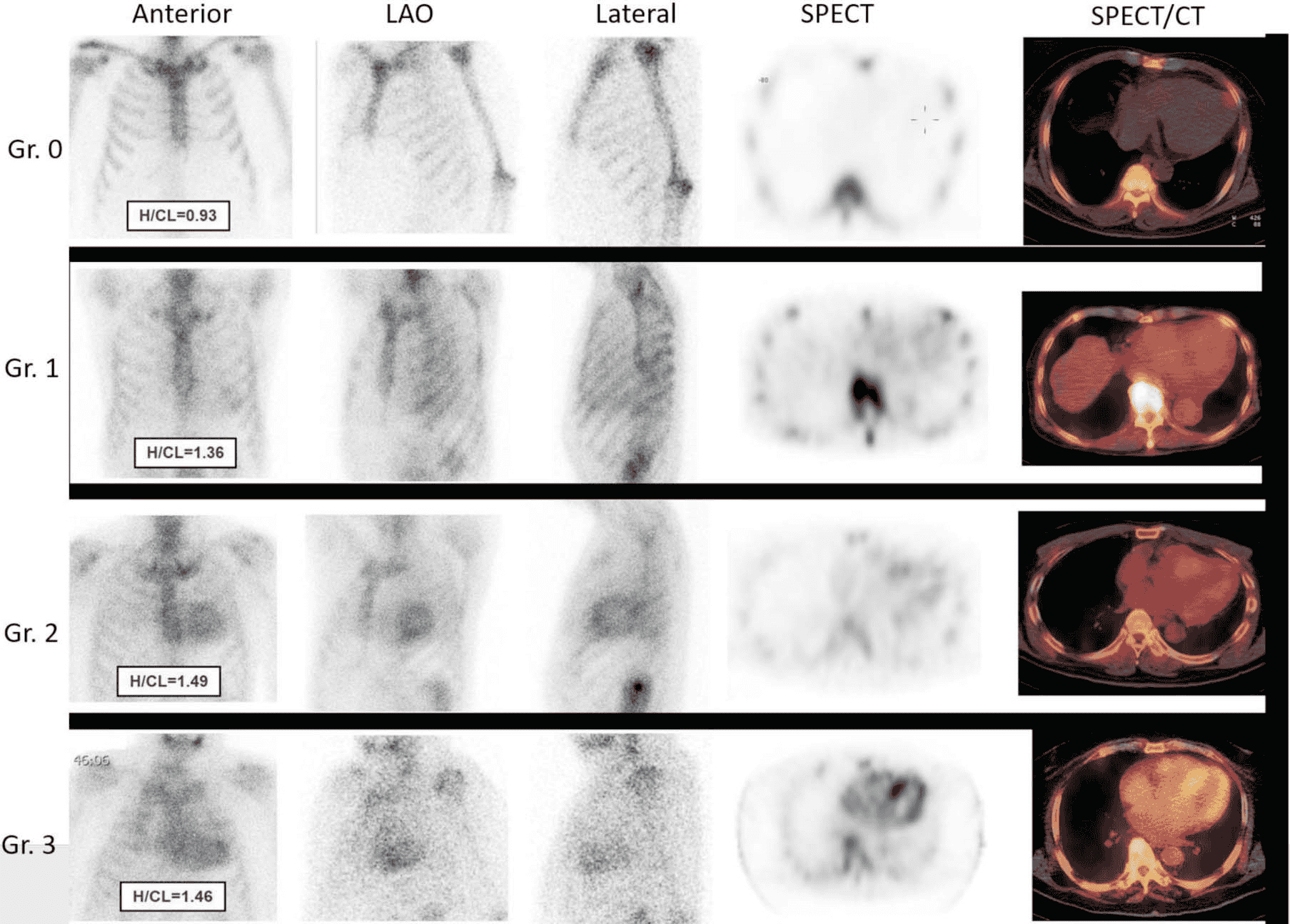 Amyloidosis 共識 — Figure 3 PYP visual scores