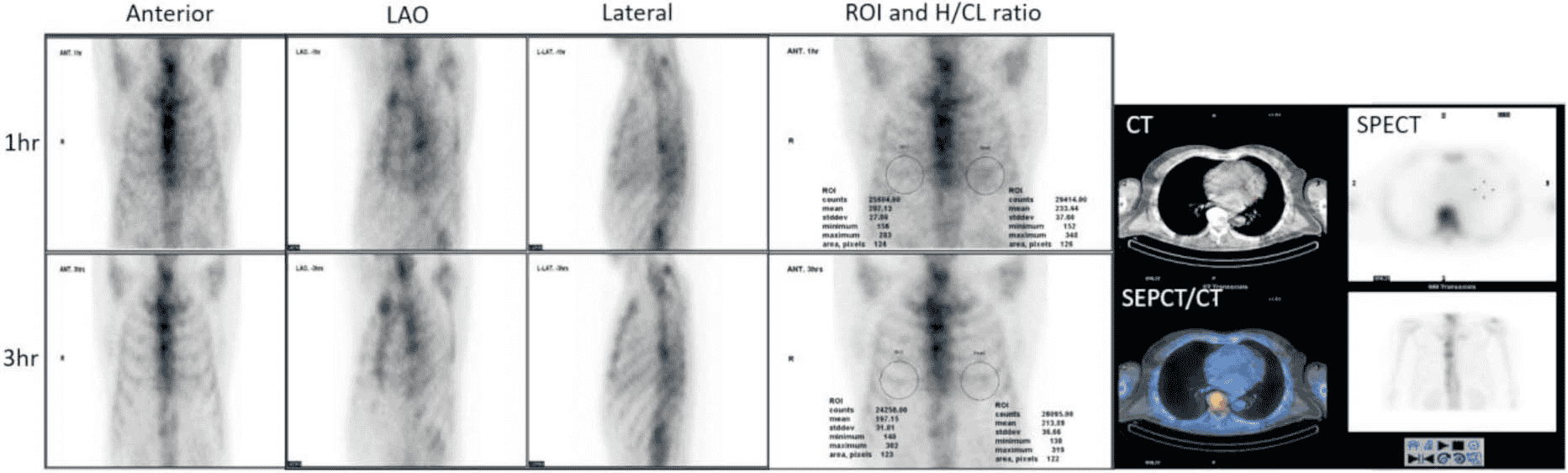 Amyloidosis 共識 — Figure 4 planar H/CL
