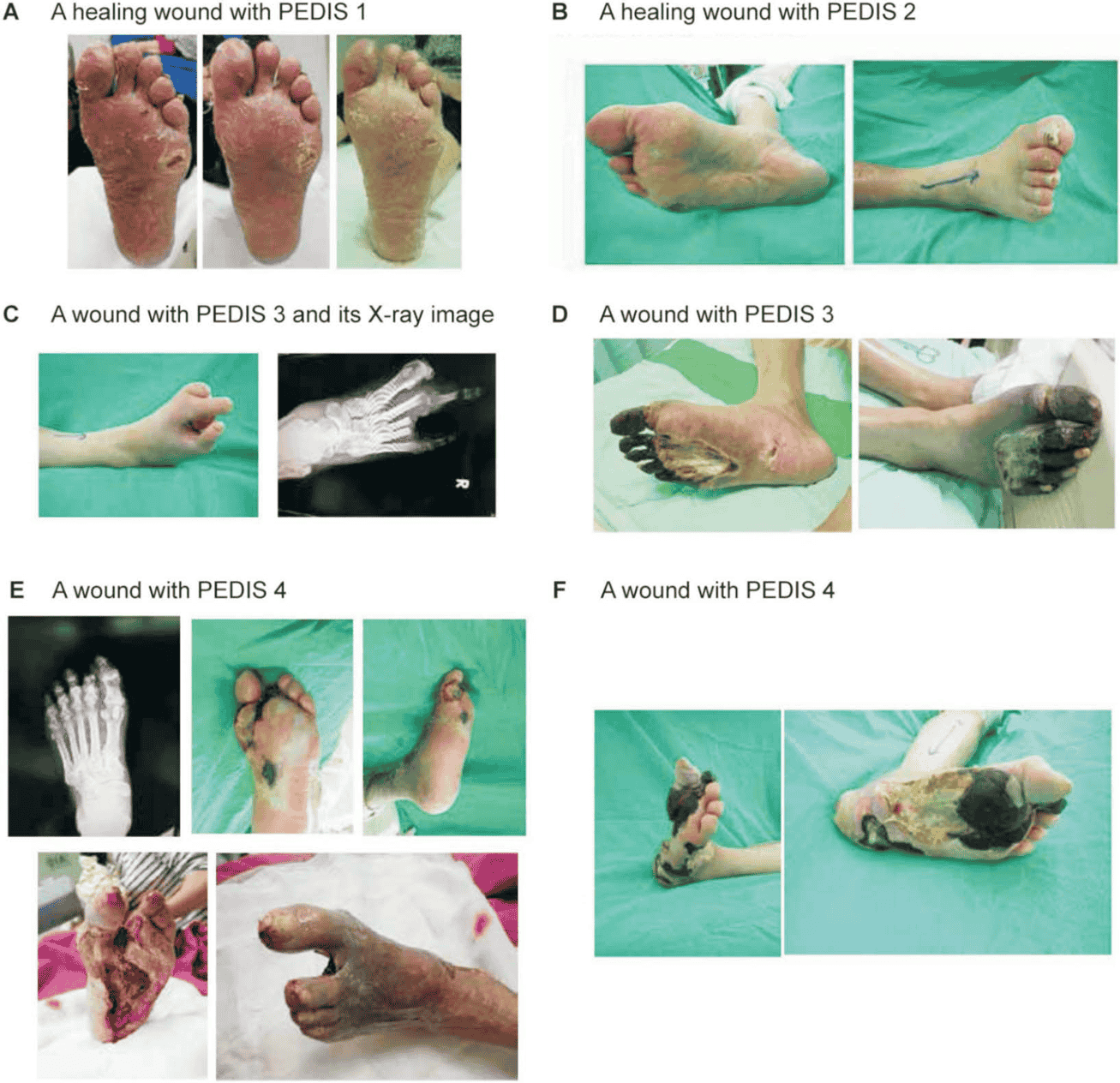 Figure 2 — PEDIS wound classification clinical photographs, panels A to F