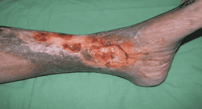 Figure 3 — A venous wound on the lower leg with stasis dermatitis