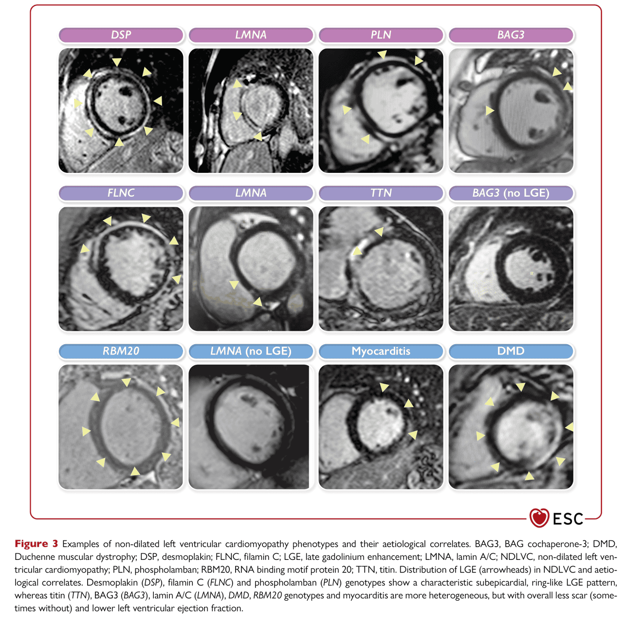 ESC cmp2023 — Figure 3 NDLVC 表型範例