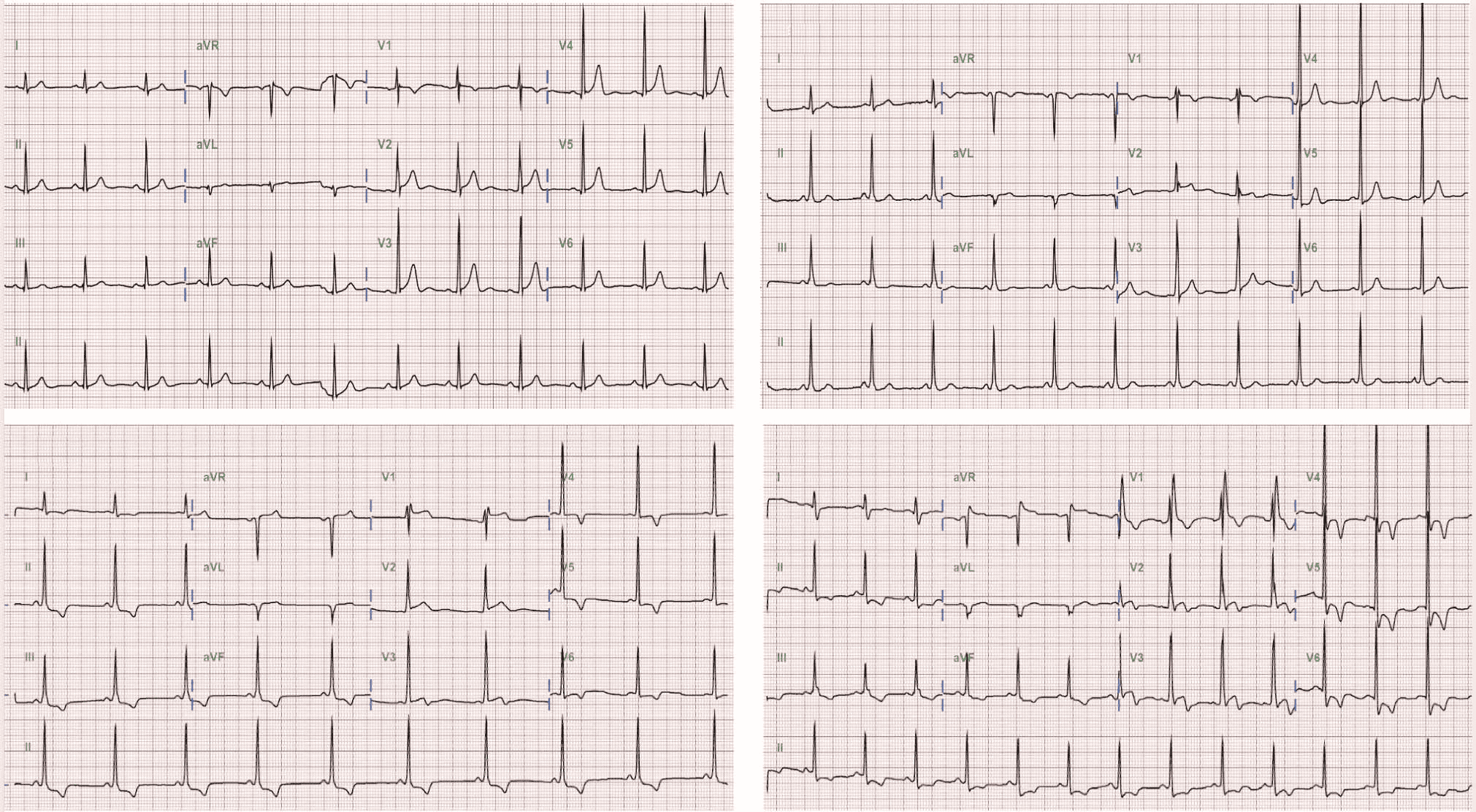 Fabry 共識 — Figure 6 ECG 演變