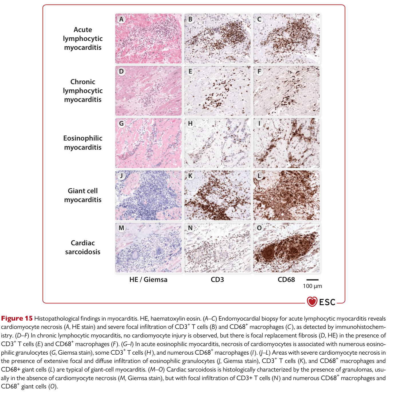 2025 ESC Myocarditis & Pericarditis — Figure 15