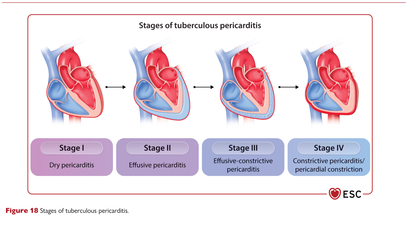 2025 ESC Myocarditis & Pericarditis — Figure 18