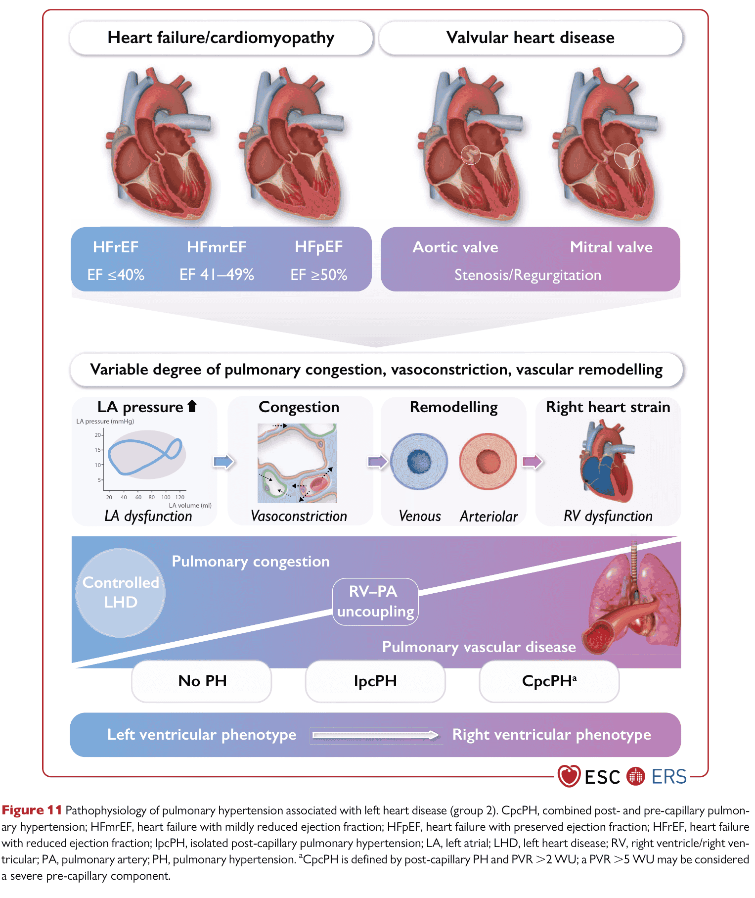 ESC PH 2022 — Figure 11 pathophysiology PH-LHD