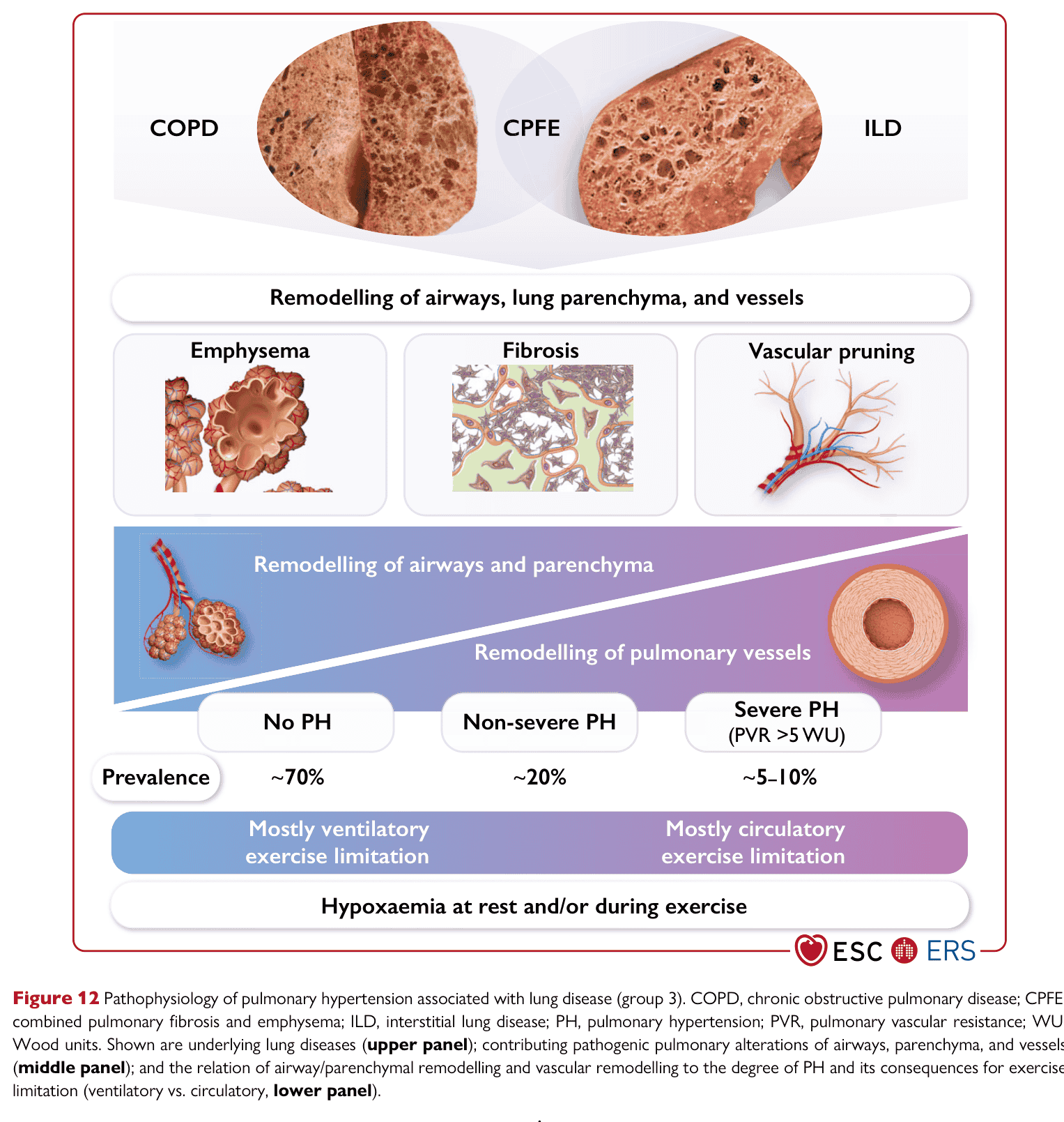 ESC PH 2022 — Figure 12 pathophysiology PH-lung disease