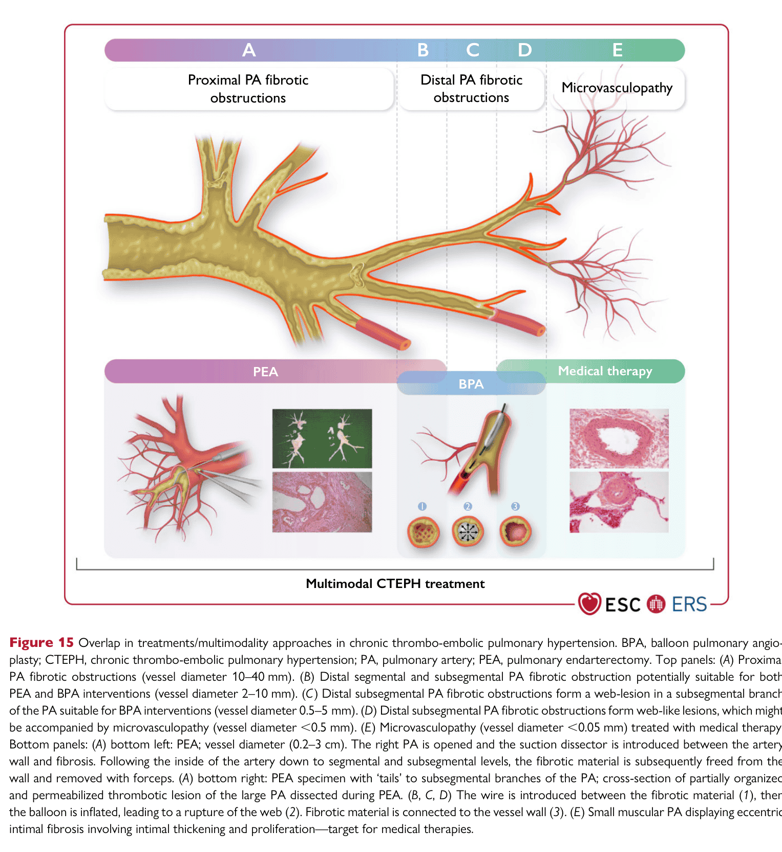 ESC PH 2022 — Figure 15 multimodality CTEPH treatment overlap