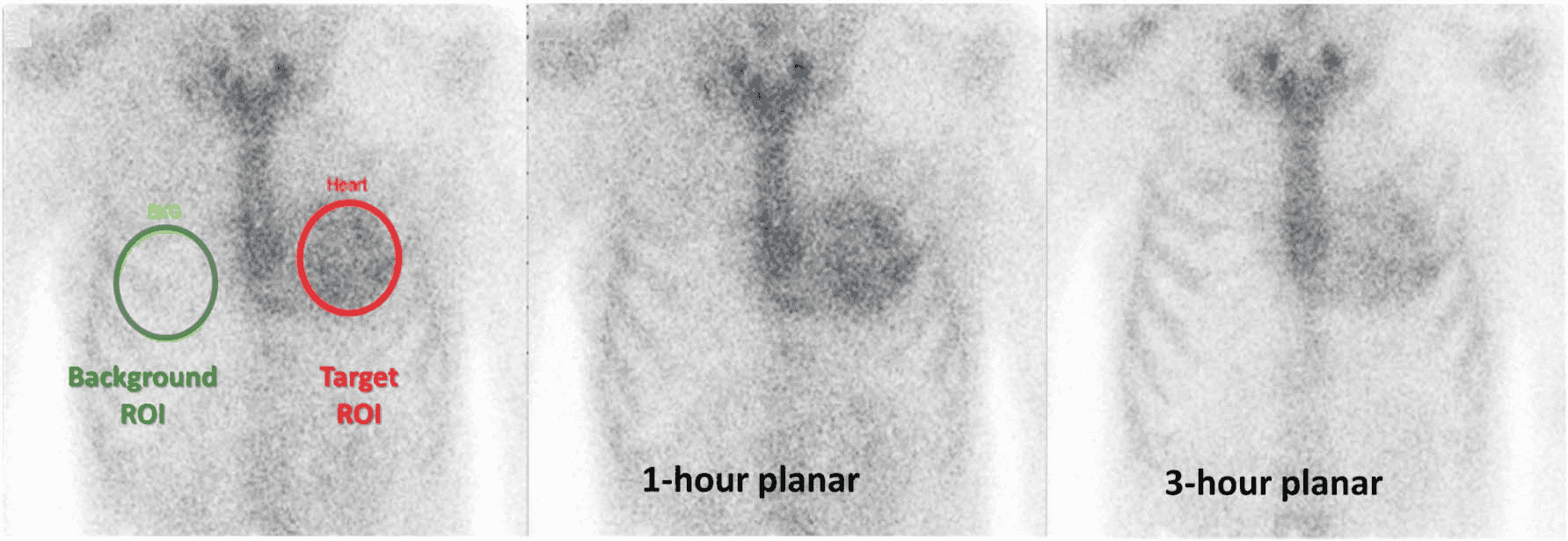 ATTR-CM PYP 共識 — Figure 2 H/CL ROI