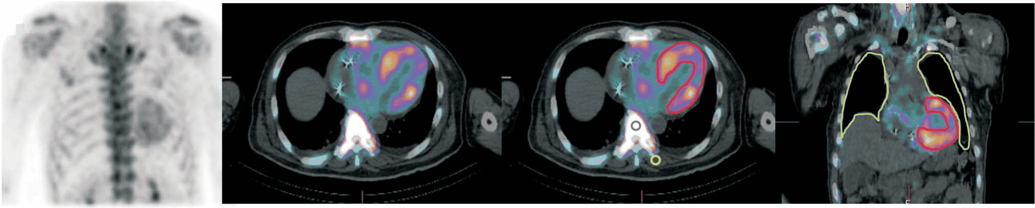 ATTR-CM PYP 共識 — Figure 3 SPECT/CT 量化