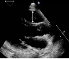 近端 RVOT 測量