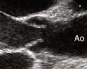 LVOT 與 AV Zoom