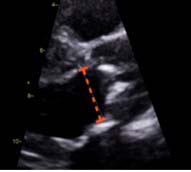 LVOT 直徑測量