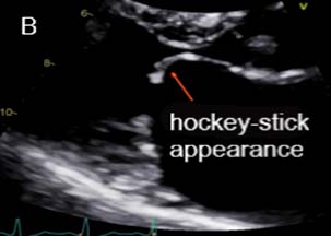 風濕性 MV hockey-stick Fig B