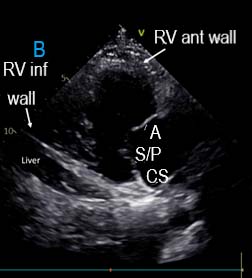 RV inflow Fig B 看不到中隔