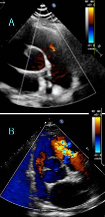RVOT/PA 測量細節