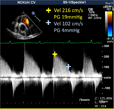 RVOT CW PR