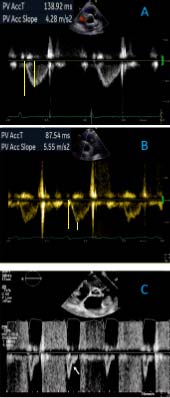 RVOT PW 加速時間與 notching