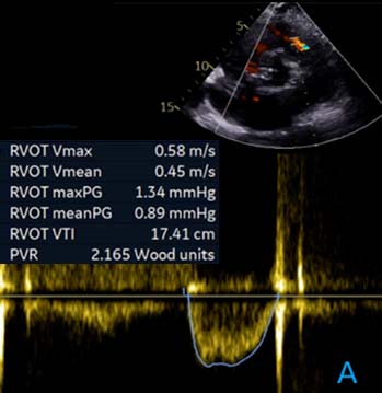 RVOT VTI 用於 PVR