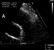 RVOT 直徑用於 Qp/Qs
