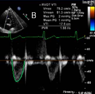 RVOT VTI 用於 Qp/Qs