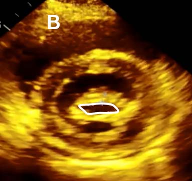 MVA planimetry Fig B