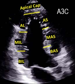 17 節段牛眼圖