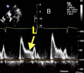 L velocity Fig B