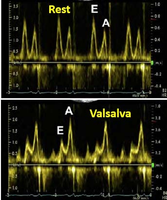 Valsalva Fig C