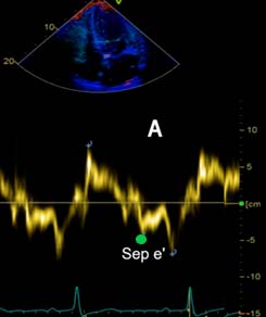 Septal e' Fig A