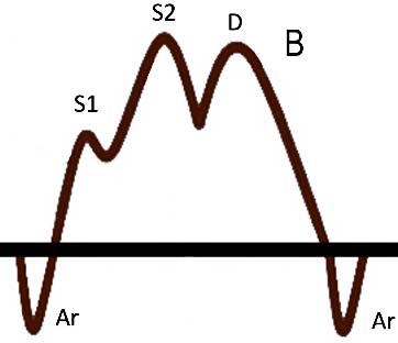 肺靜脈 S1 S2 Fig B