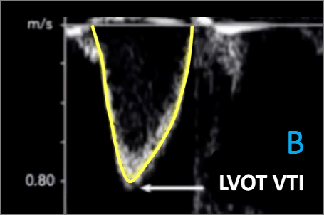 LVOT VTI Fig B 波形