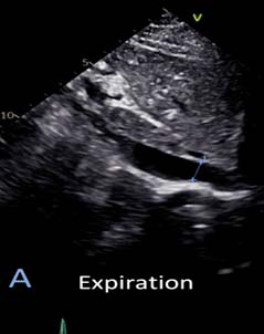 IVC Fig A 吐氣