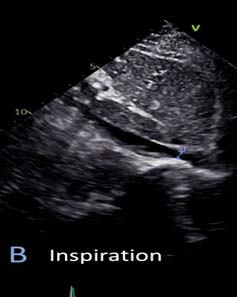 IVC Fig B 吸氣