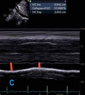 IVC M-mode Fig C