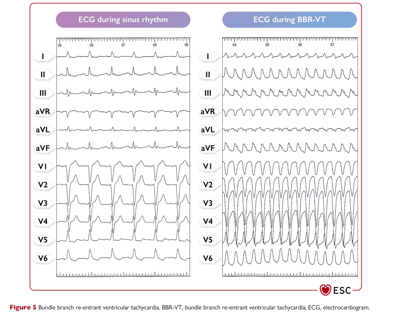 ESC va2022 — Figure 5 BBR-VT