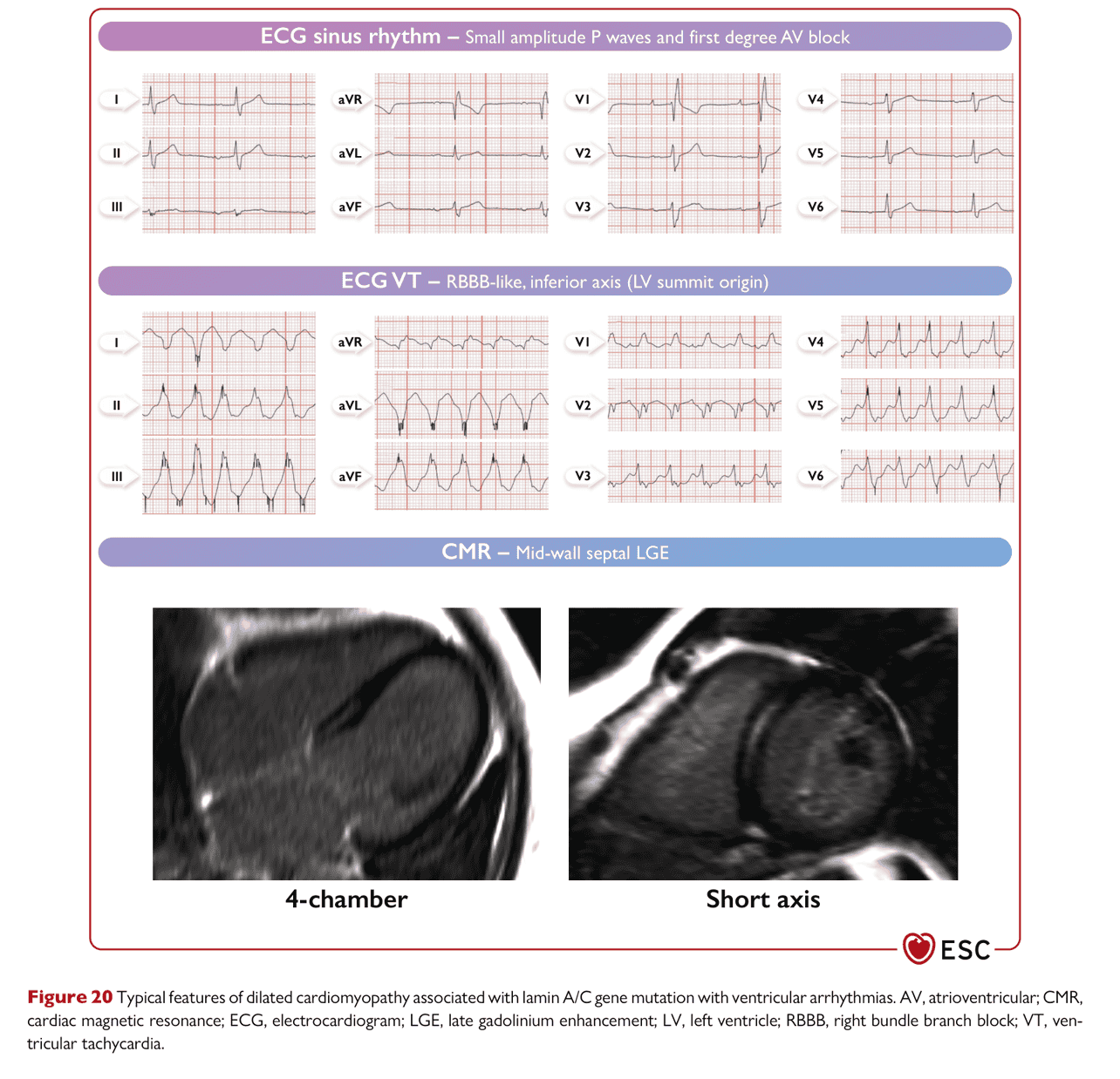 ESC va2022 — Figure 20 LMNA DCM 特徵