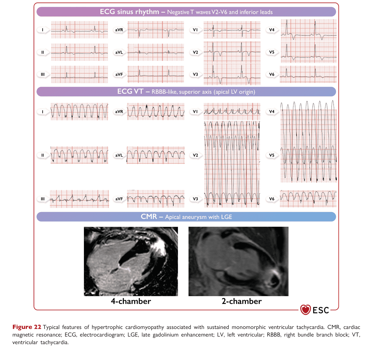 ESC va2022 — Figure 22 HCM 特徵