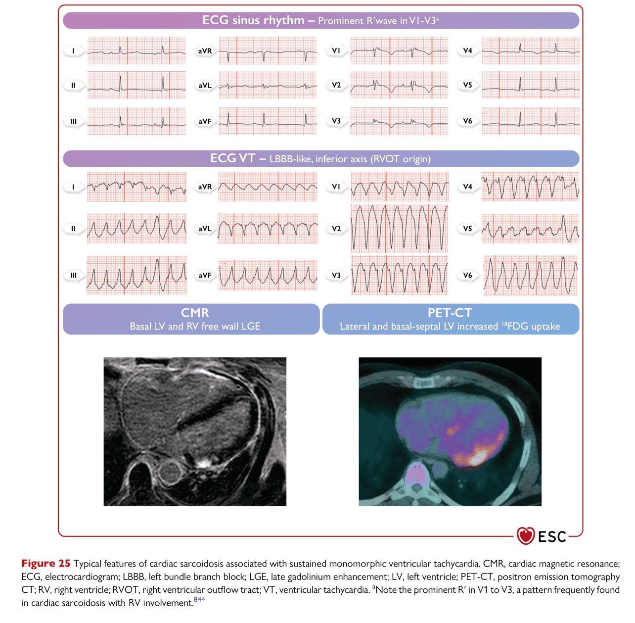 ESC va2022 — Figure 25 cardiac sarcoidosis 特徵