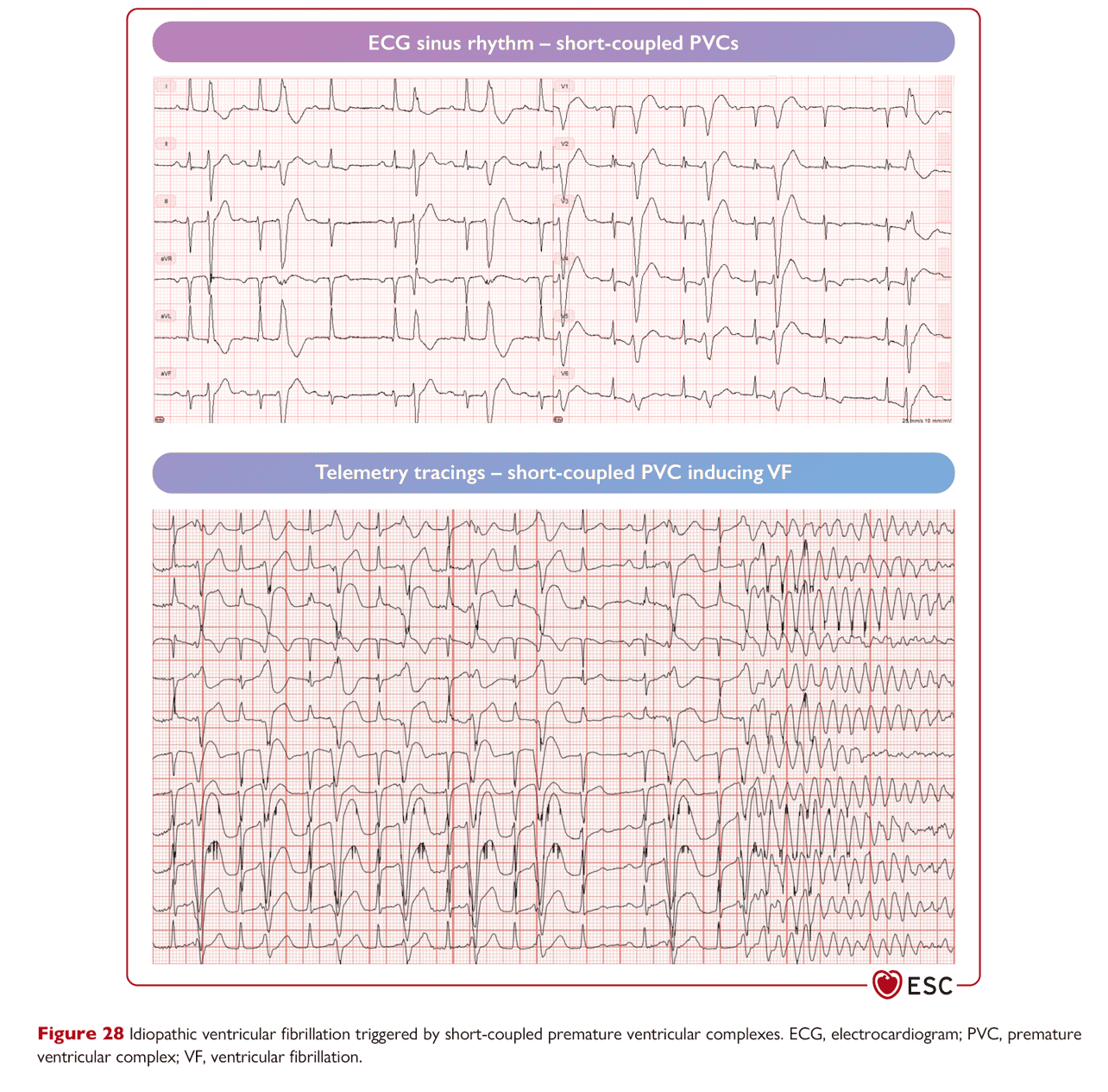 ESC va2022 — Figure 28 短聯律 PVC 誘發 VF