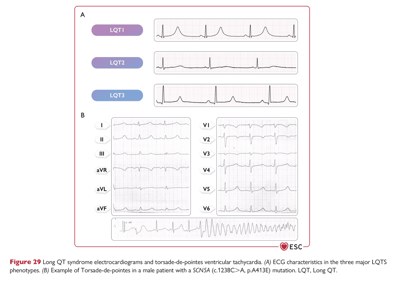 ESC va2022 — Figure 29 LQTS ECG