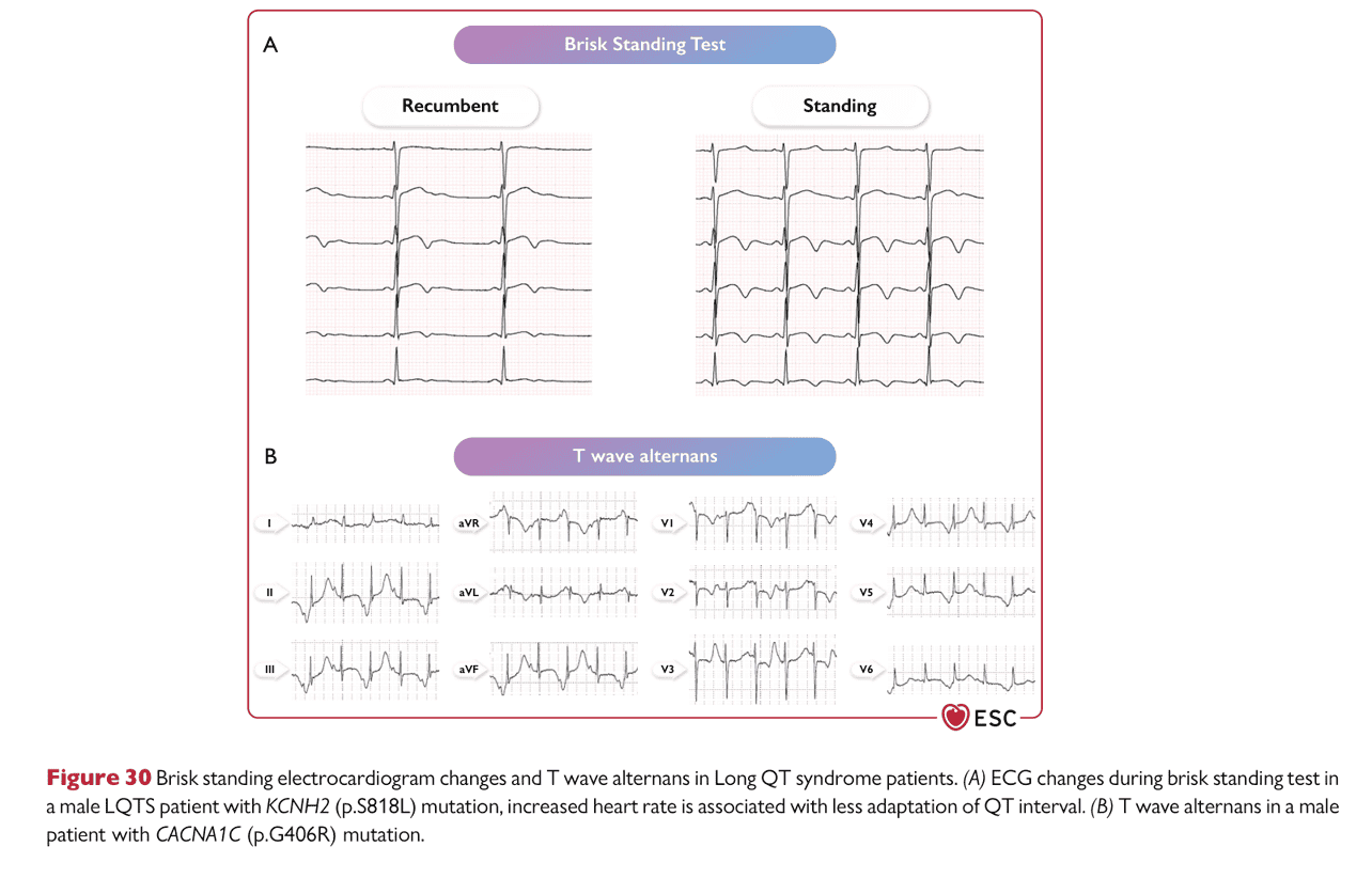 ESC va2022 — Figure 30 brisk standing / T wave alternans