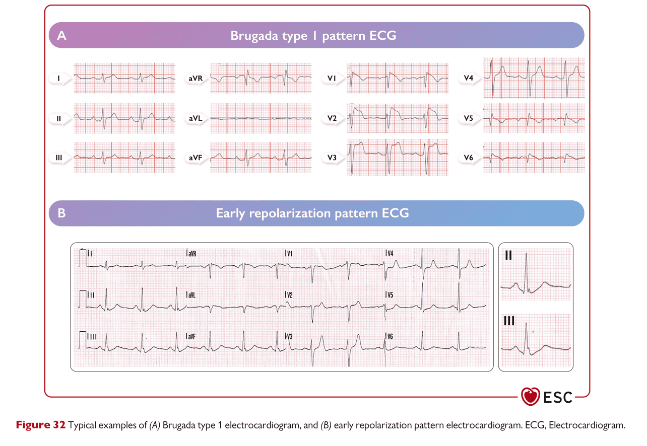 ESC va2022 — Figure 32 Brugada / 早期再極化 ECG