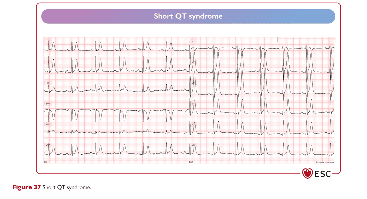 ESC va2022 — Figure 37 短 QT