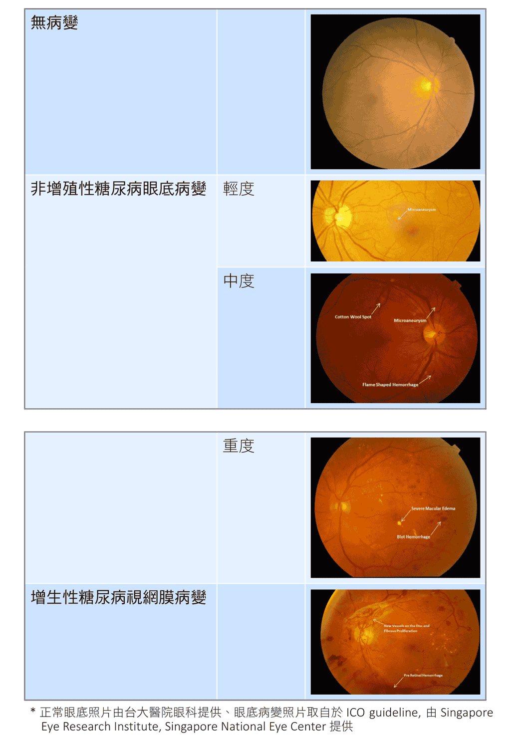 原文圖：糖尿病眼底病變嚴重程度區分（眼底照片表）